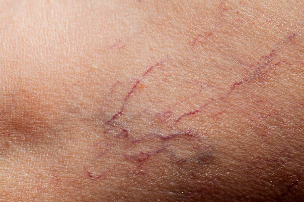 Spider Veins